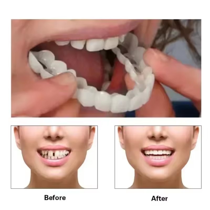 Teeth Veneers Whitening Dentur - Teeth Whitening With Braces ulasan dan harga