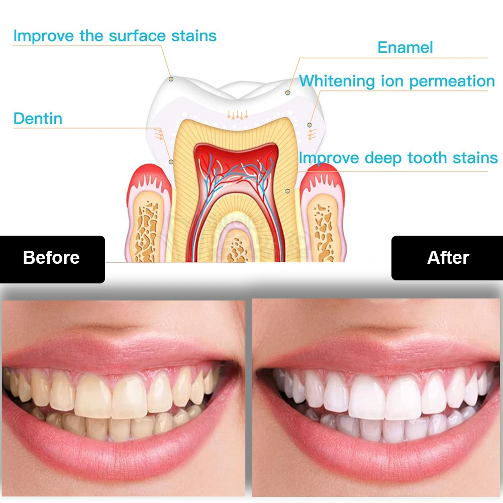 Dental Teeth Whitening Kit Min - Teeth Whitening Essence ulasan dan harga
