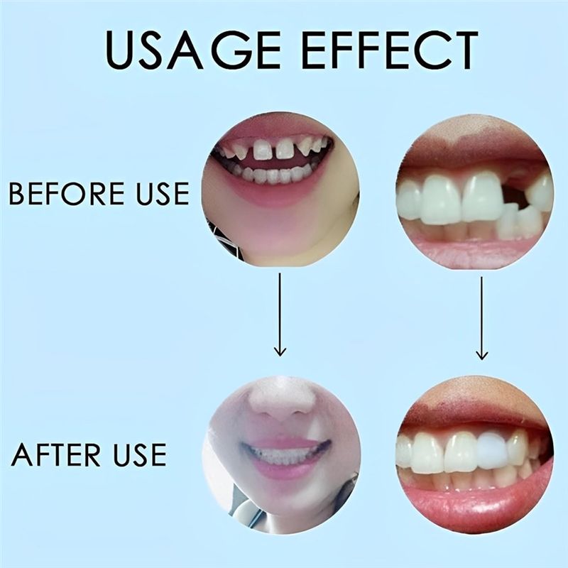 [NEW!ABMK】 2 Pairs,Regain Beau - Teeth Whitening With Braces ulasan dan harga